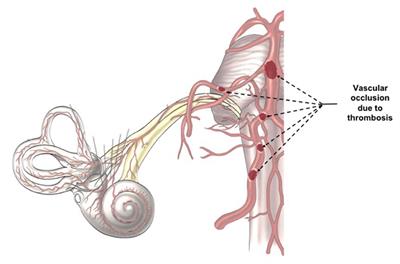 Corrigendum: Auditory disturbances and SARS-CoV-2 infection: brain inflammation or cochlear affection? Systematic review and discussion of potential pathogenesis